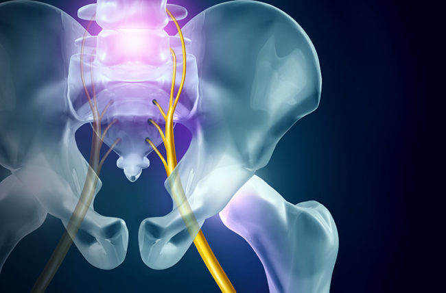 Sciatic Nerve Pain And How To Help It